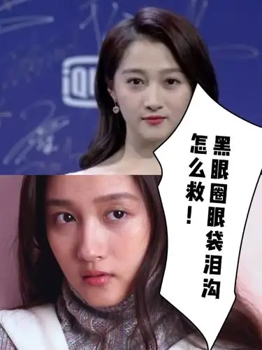 年仅23岁的关晓彤黑眼圈严重,可见黑眼圈,眼袋,泪沟问题真的困扰了不