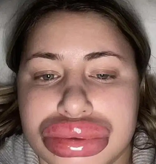 美国女子做丰唇手术过敏肿胀8倍成香肠嘴差点危及生命