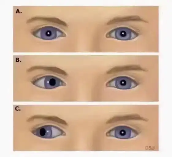 每天科普9595什么是斜视[疑问] "斜视眼"是指两眼不能 - 抖音