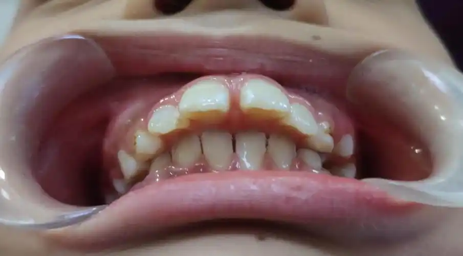 龅牙需早期干预~记一个小帅哥的成长.