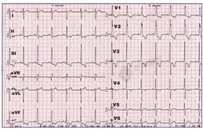 心电图|心肌缺血|肺栓塞_网易订阅