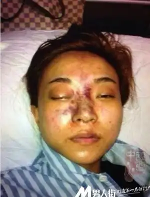 女孩注射玻尿酸:10秒后双目失明!