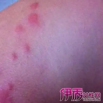 【图】虱子咬的症状图片大全 被虱子咬了后的四大症状揭晓