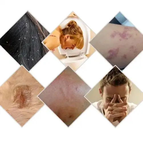 人被虱子咬过的症状