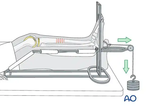看完骨科医生打牵引我整个人都不好了