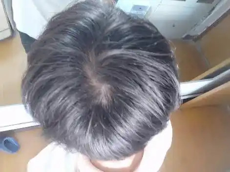 头顶脱发这样算正常吗