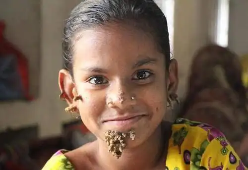 全球首位"女树人":生活发生了180度大转变