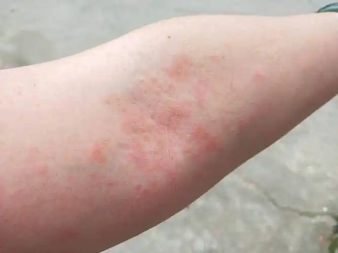 9岁女孩确诊皮肤癌,奶奶后悔痛哭,医生怒斥:成天给她穿些什么