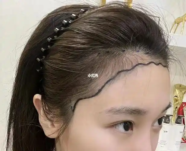 女士发际线