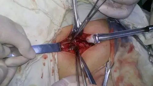 昨晚做的一例阑尾炎手术(附图片)