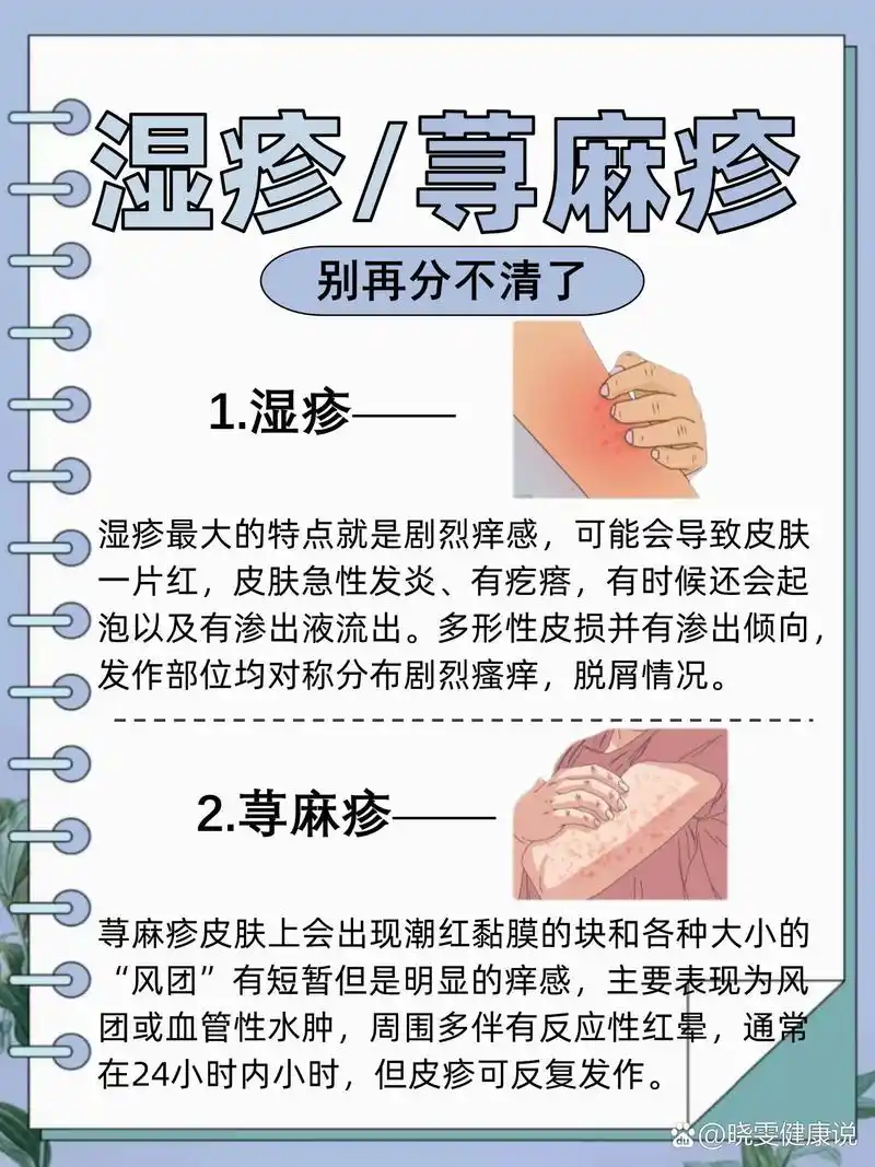 湿疹荨麻疹还在傻傻分不清?
