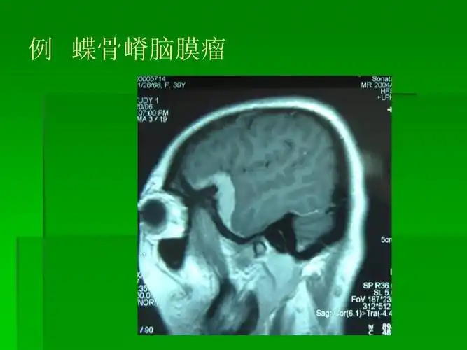 例 蝶骨嵴脑膜瘤
