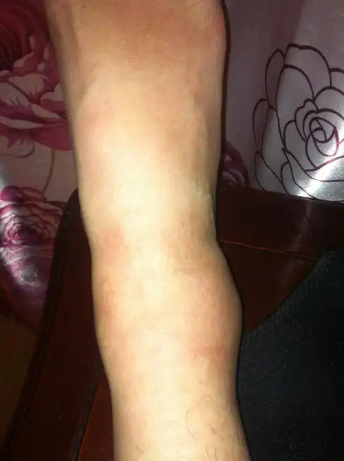 那位专家可以帮我看看,为什么扭脚一个月了,这还是肿,但摸着不痛!