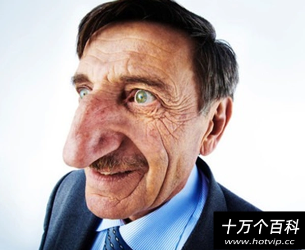 世界上长得最恐怖的人:湖南象人黄春才(脸上15公斤神经纤维瘤) - 火烩