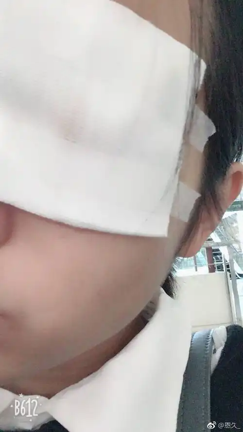 29号,然后第二天就拆了纱布,其实就差不多好了,就有点紫血,其实感觉