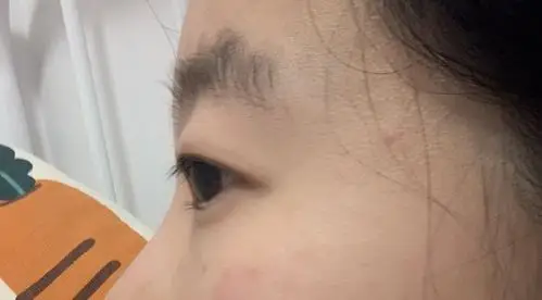 眼球的凸度以眉骨做参考,眼球的凸度可以分为凹陷的平_圈子-新氧美容