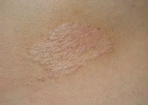 这种症状是不是湿疹