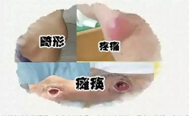 5,髋关节结核,患肢关节伸屈困难,大腿,臀部肌肉萎缩,两臀部肌肉不对称