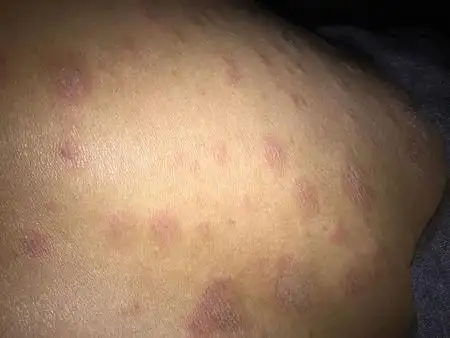 买什么药好呢 追答: 称为汗癣,顾名思义,冒汗多后,拖延了时间才清洁就