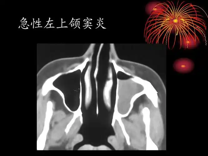 急性左上颌窦炎