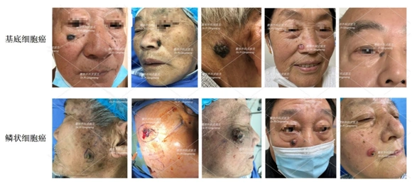 发病率比较低的还有恶性黑色素瘤,鲍恩病,pagets病,疣状癌,毛母质癌