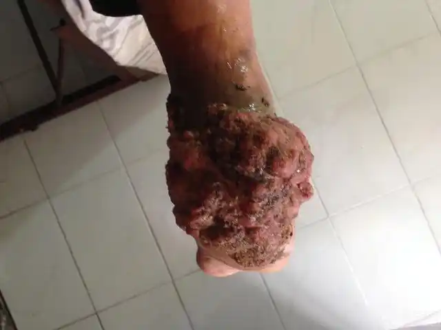 专科情况:右足跟部见大量肉芽组织生长,显菜花状,大量中草药外敷,恶臭