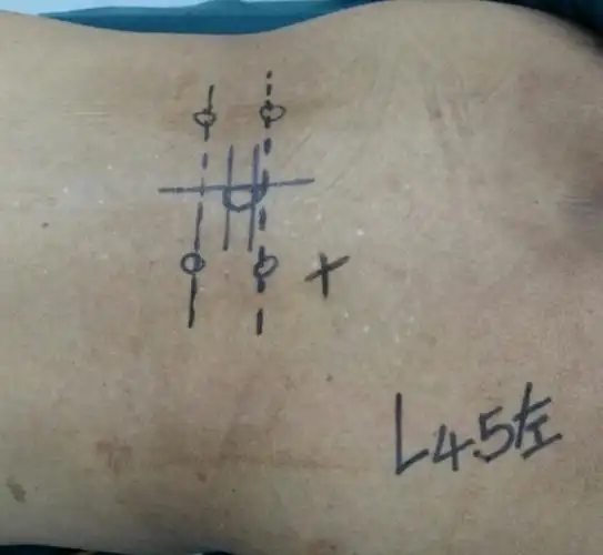 其它 脊柱内镜下减压植骨融合手术 写美篇诊断:        腰椎管狭窄症