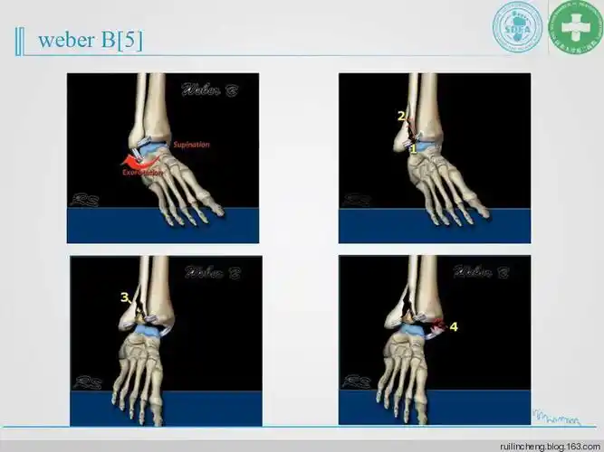 踝关节骨折的分型