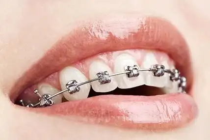 有关:每一个人的牙齿的情况是不一样的,选择的牙齿矫正的方式也会不同