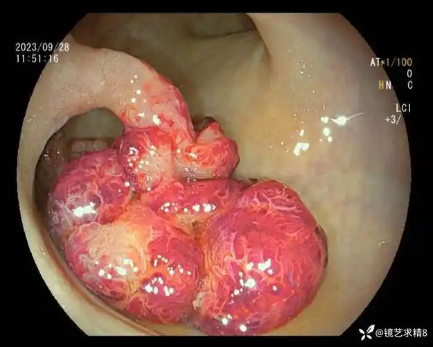 伪装成痔疮脱出的直肠息肉