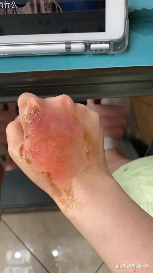甜都给你 的想法: 浅二度烫伤,皮差不多褪完了,什么时候才… - 知乎