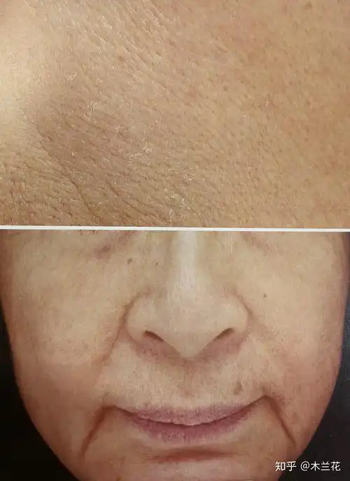 细纹爬上来怎么办悲伤那么大35岁0细纹秘籍