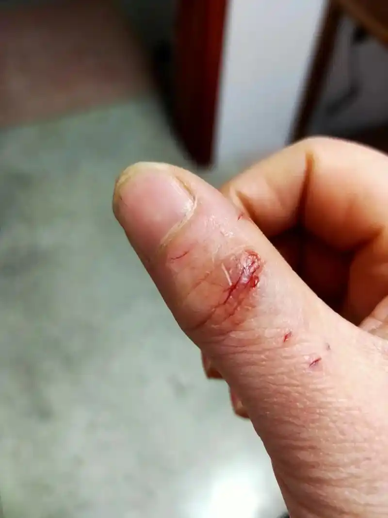 给大家分享一个被狗咬的图片,2月份被狗咬去医院打血清和疫苗, - 抖音