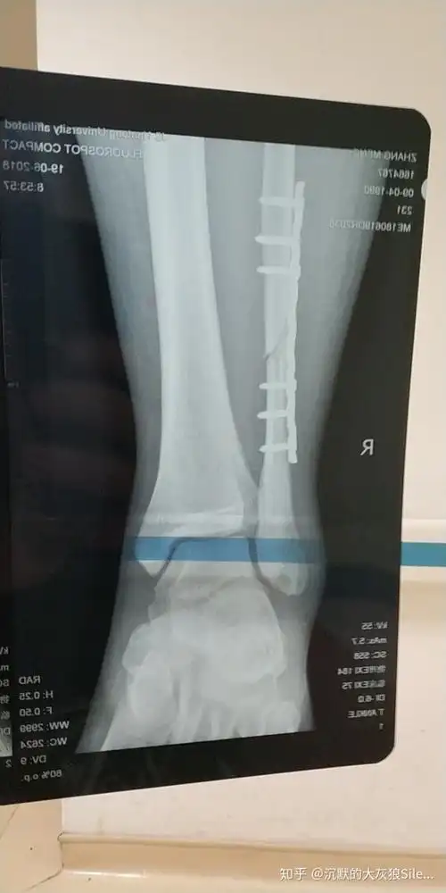 腓骨骨折的这些天 - 知乎