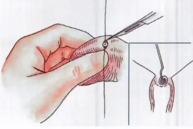 男性结扎术哪种最安全(曾经盛极一时的男性结扎术)(2)