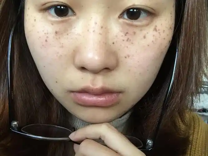 小时候也经常在外面玩,晒得像黑炭似得,之前也不注重防晒,脸上的斑点