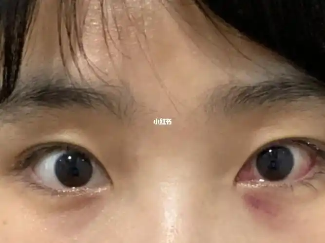 斜视手术后第十五天