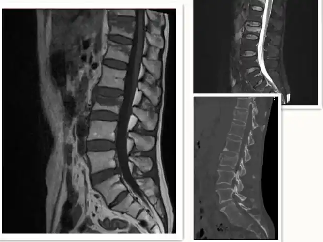 骨科二区开展首例椎体压缩性骨折经皮椎弓根钉内固定术