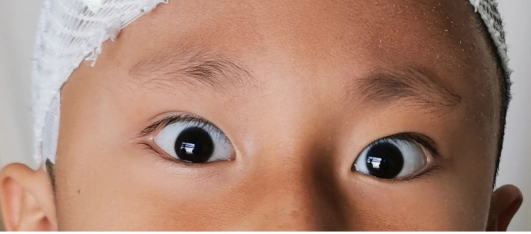 术后患者双眼球"落日征"消失