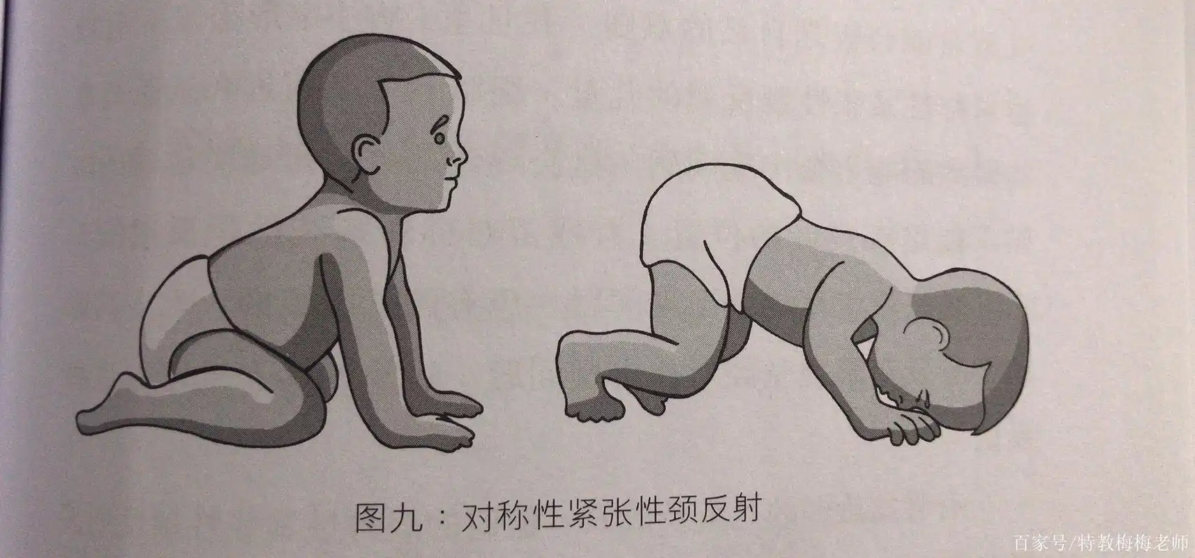 和多动症,注意力相关的原始反射——对称性紧张性颈反射