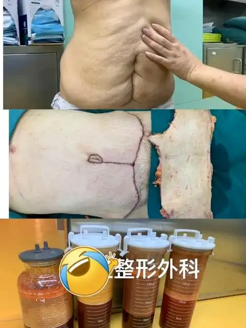 96腹壁成形术后对比,传说中的切腹91打造平坦小蛮腰,紧致腰腹