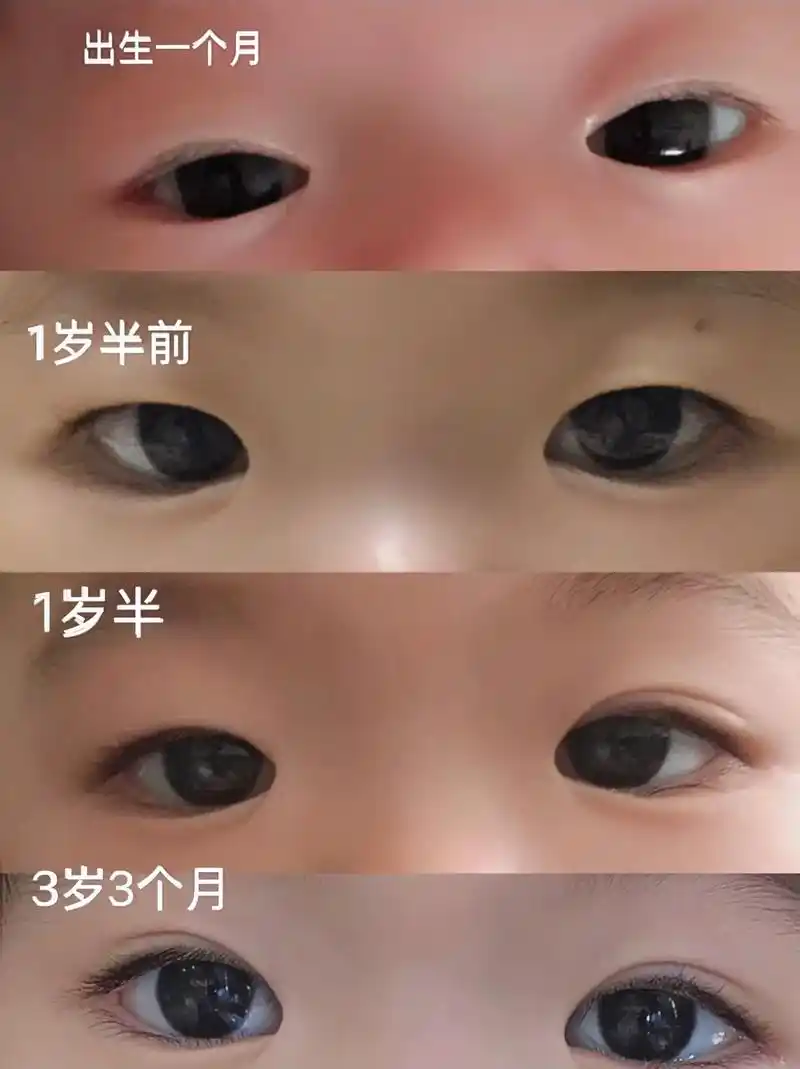 双眼皮会迟到,但不会缺席,历经三年成功双眼皮逆袭成功啦!