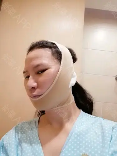 成都拉皮手术提升好不好_效果图_自由自在love拉皮手术提升术后第7天