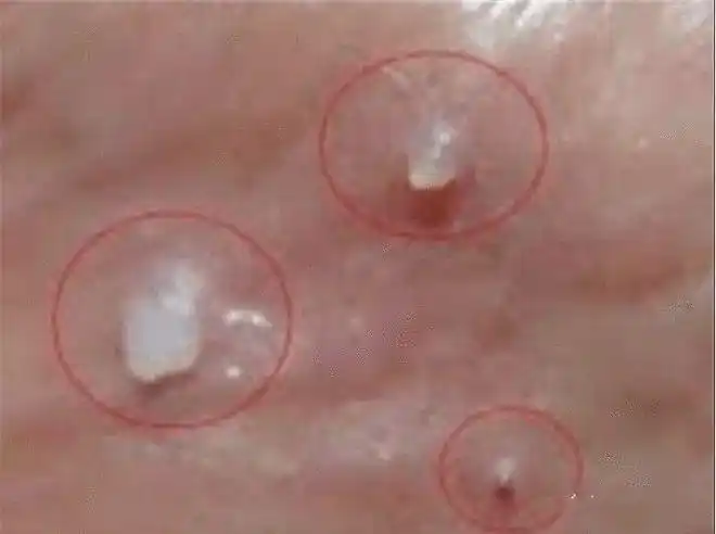 羞羞的地方长了小疙瘩是得了那种病吗你想要了解的都在这儿了