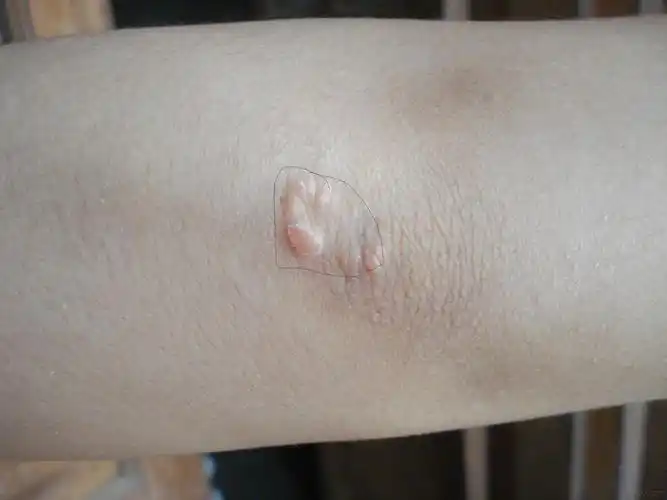 银屑病图片 - 皮肤及性传播疾病讨论版 - 爱爱医医学论坛