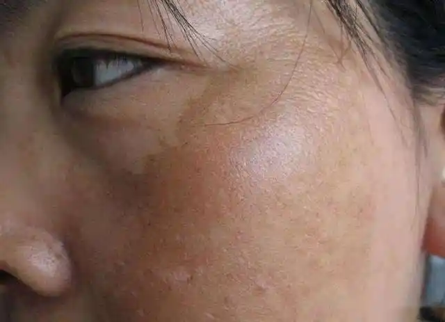 古时称黄褐斑为黧黑斑,因肝病引起者称为"肝斑";因妊娠引起者称为"