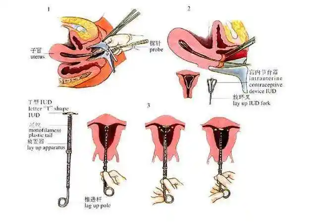 什么时候上环取环好