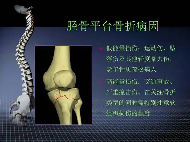 胫骨平台骨折的外科治疗汇编