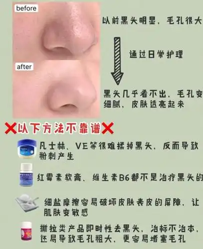 有效去黑头!告别毛孔粗大!