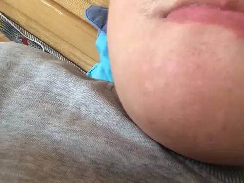 问:我的下巴发现一些白点,这是怎么回事?是不是白癜风?